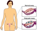 Living with Infertility